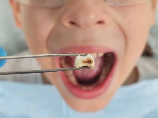Best Emergency Tooth Extraction in Slidell, LA